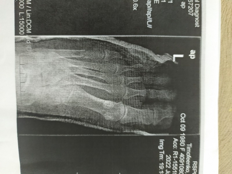 Закрытый перелом костей плюсны карта вызова