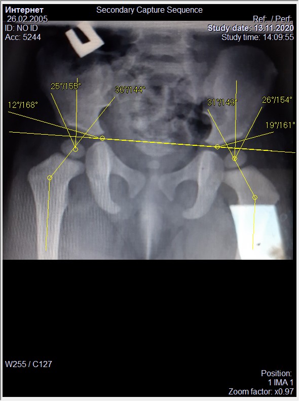 Ацетабулярный угол норма у детей. Ядра окостенения головок бедренных костей. Ацетабулярную дисплазию. Ядра окостенения тазобедренных суставов. Ядро окостенения тазобедренного сустава у грудничка норма.