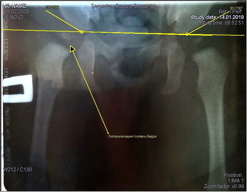 Ядро окостенения тазобедренного сустава у грудничка. Гипоплазия ядер окостенения бедер. Ядра окостенения тазобедренных суставов. Ядра окостенения на снимке.