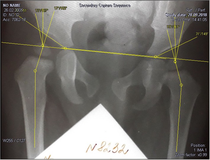 Норма углов. Ацетабулярный индекс тазобедренных суставов норма. Ацетабулярный угол дисплазия. Дисплазия тазобедренных суставов.